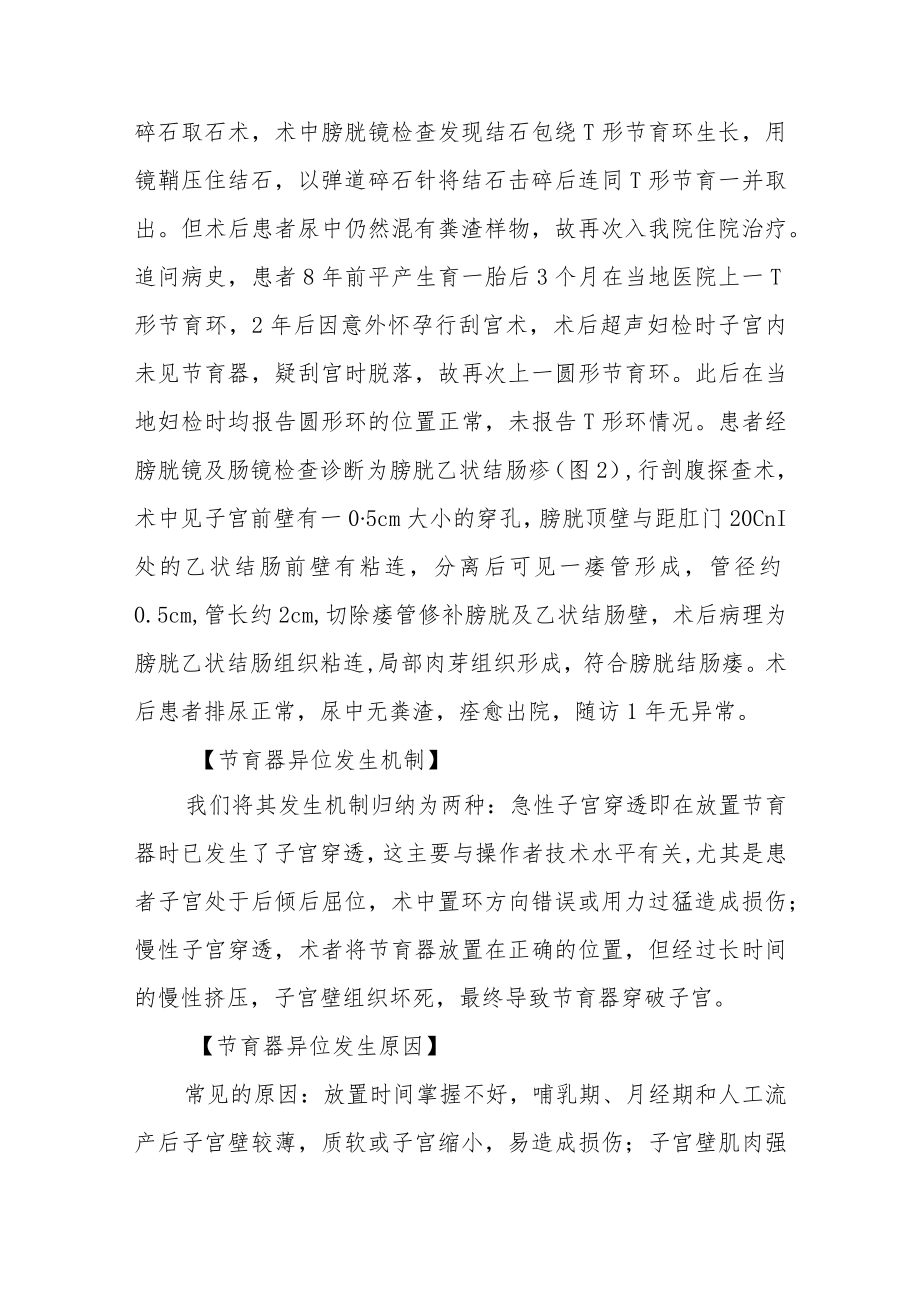 妇产科医师晋升副主任（主任）医师高级职称病例分析专题报告（节育器异位穿透膀胱）.docx_第3页
