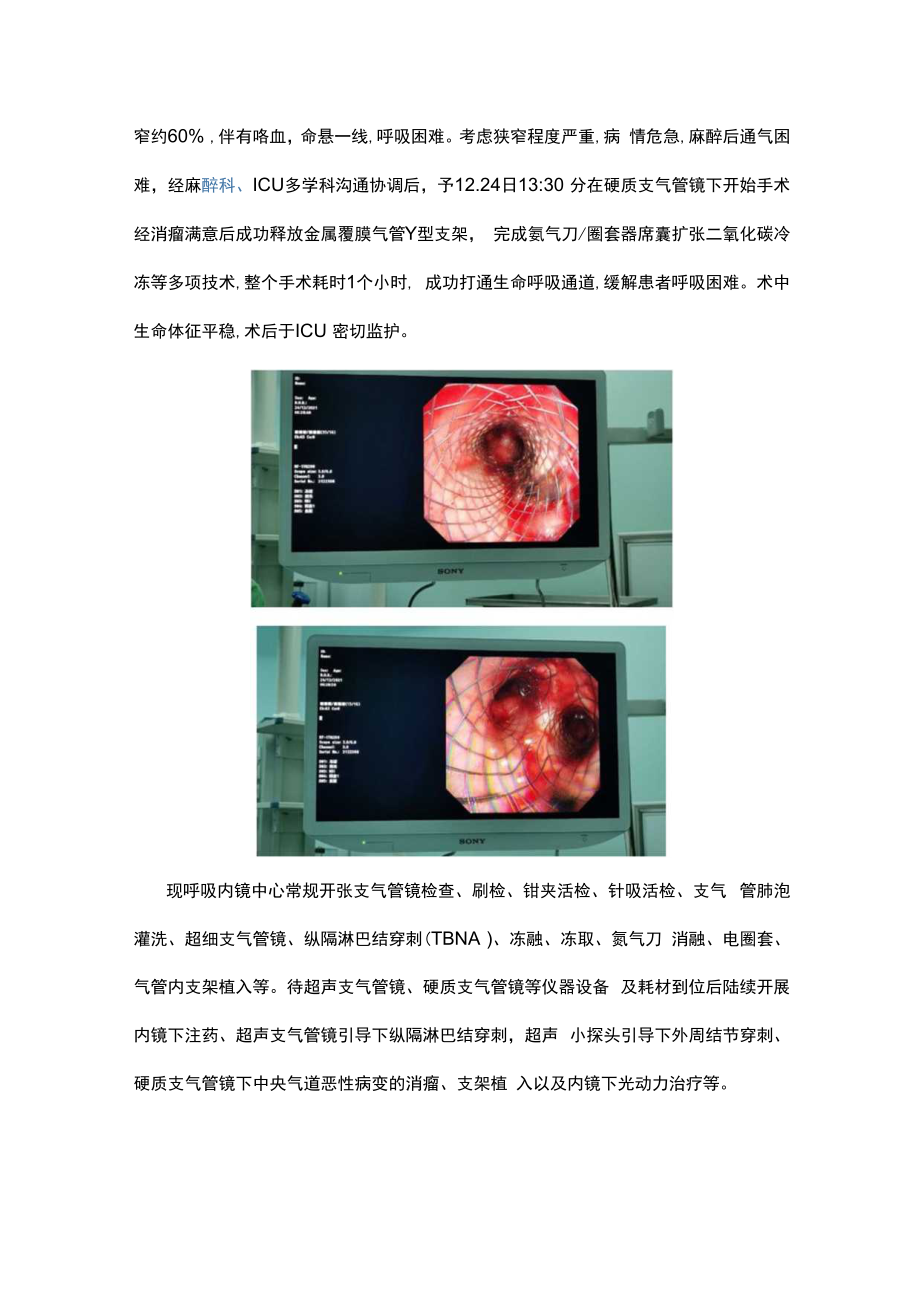 硬质支气管镜下支架植入术.docx_第3页