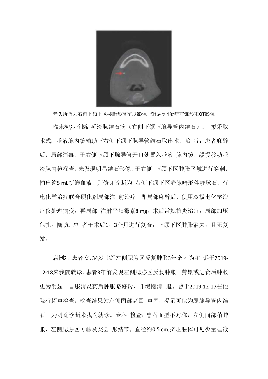 颌面外科医师晋升副主任（主任）医师例分析专题报告（颌面部静脉畸形伴静脉石）.docx_第3页