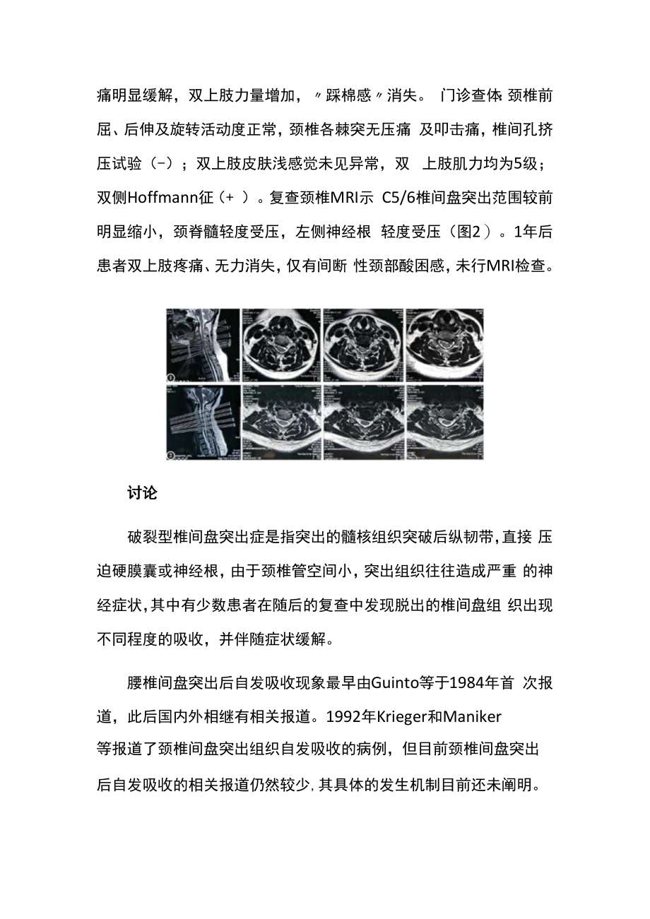 脊柱外科医师晋升副主任(主任)医师例分析专题报告(颈椎间盘突出症患者脱出髓核).docx_第3页
