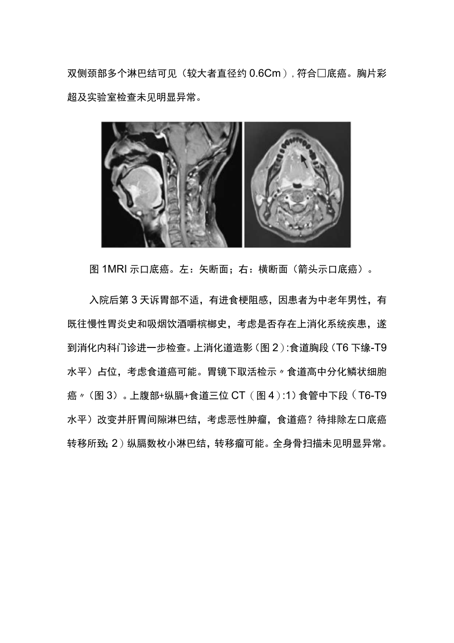 肿瘤科医师晋升副主任医师高级职称专题报告病例分析（口底癌同期并食道癌病例分析）.docx_第3页