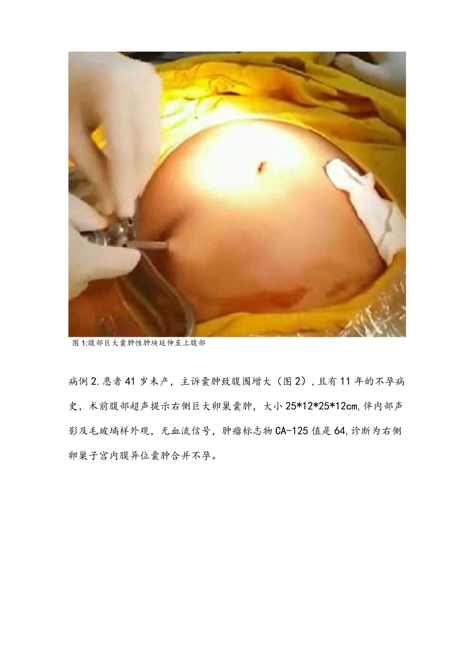 腹腔镜手术前盲穿抽液法治疗巨大卵巢囊肿.docx_第3页