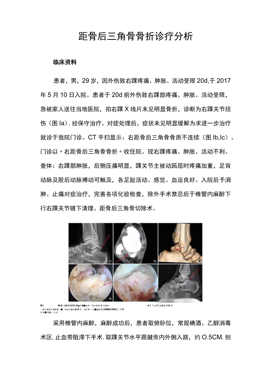 骨科医师晋升副主任（主任）医师病例分析专题报告（距骨后三角骨骨折诊疗）.docx_第2页