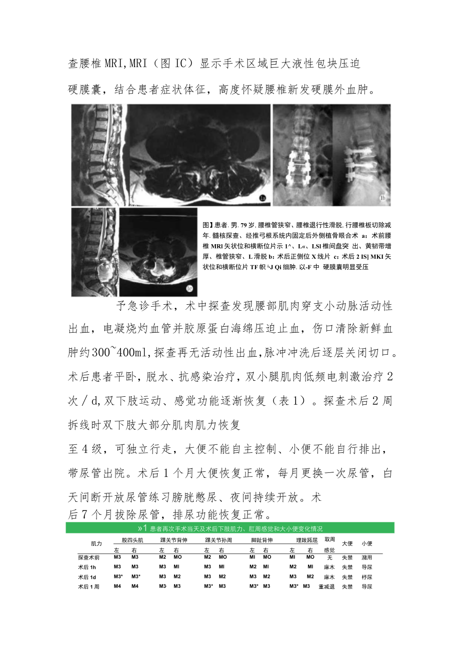 骨外科晋升副主任（主任）医师病例分析专题报告（腰椎术后2周突发硬膜外血肿病例分析）.docx_第3页