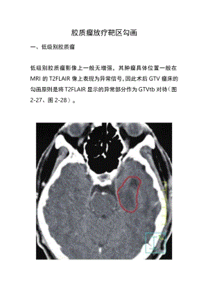 胶质瘤放疗靶区勾画.docx