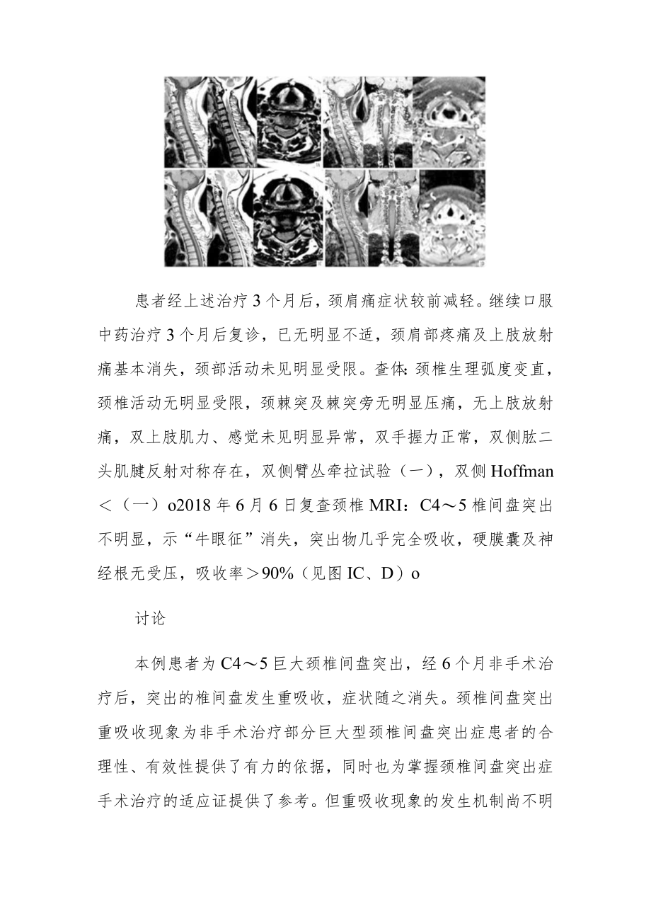 脊柱外科晋升副主任（主任）医师病例分析专题报告（颈椎间盘突出后重吸收）.docx_第3页