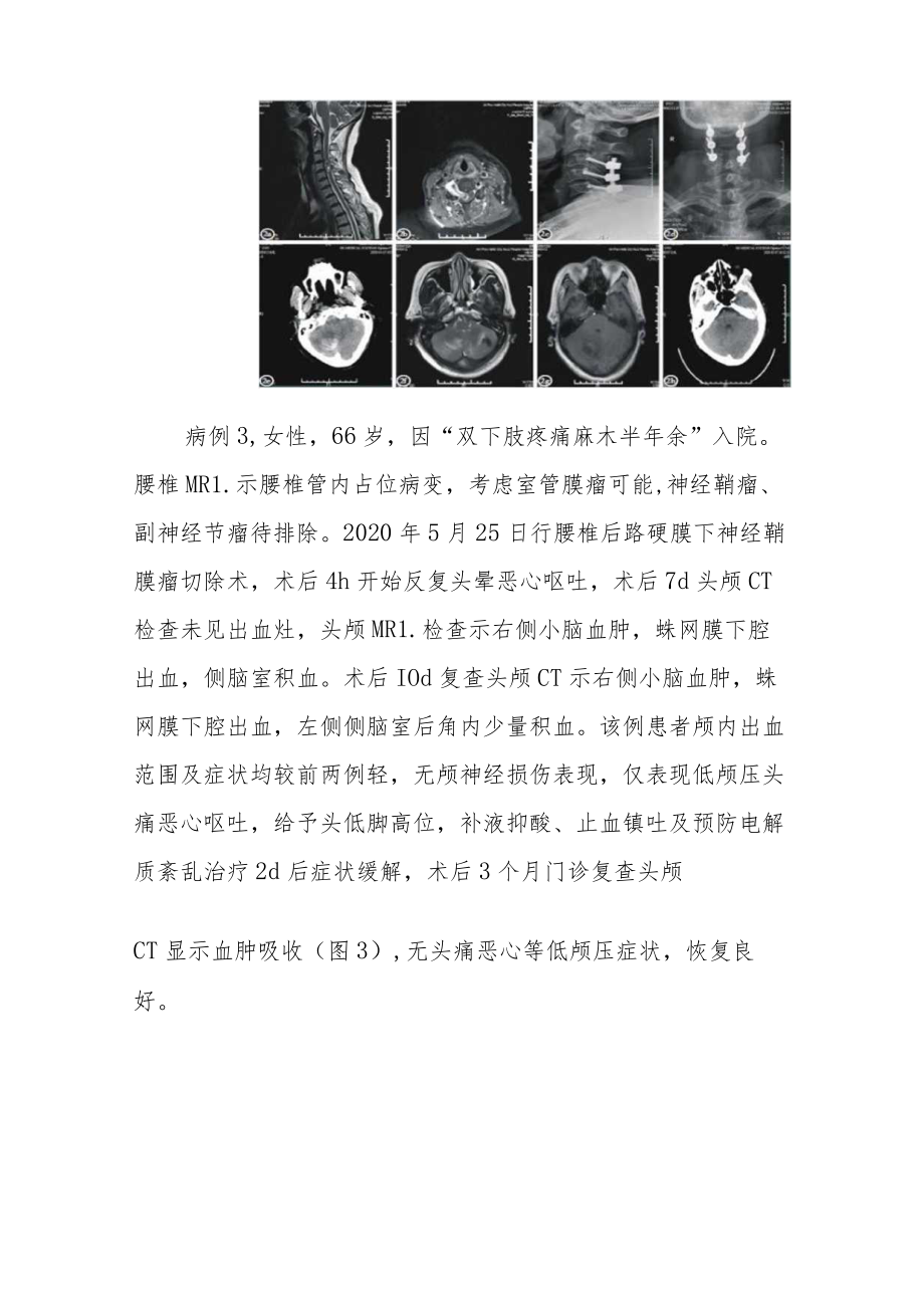 脊柱术后脑脊液漏伴颅内出血3例病例分析专题报告.docx_第3页