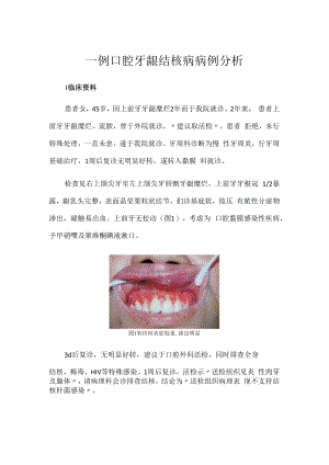 一例口腔牙龈结核病病例分析.docx