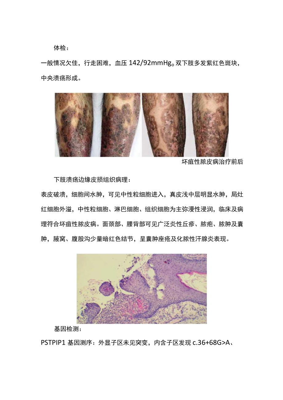 神经内科医师晋升副主任医师高级职称专题报告病例分析（PAPASH综合征病例分析）.docx_第3页