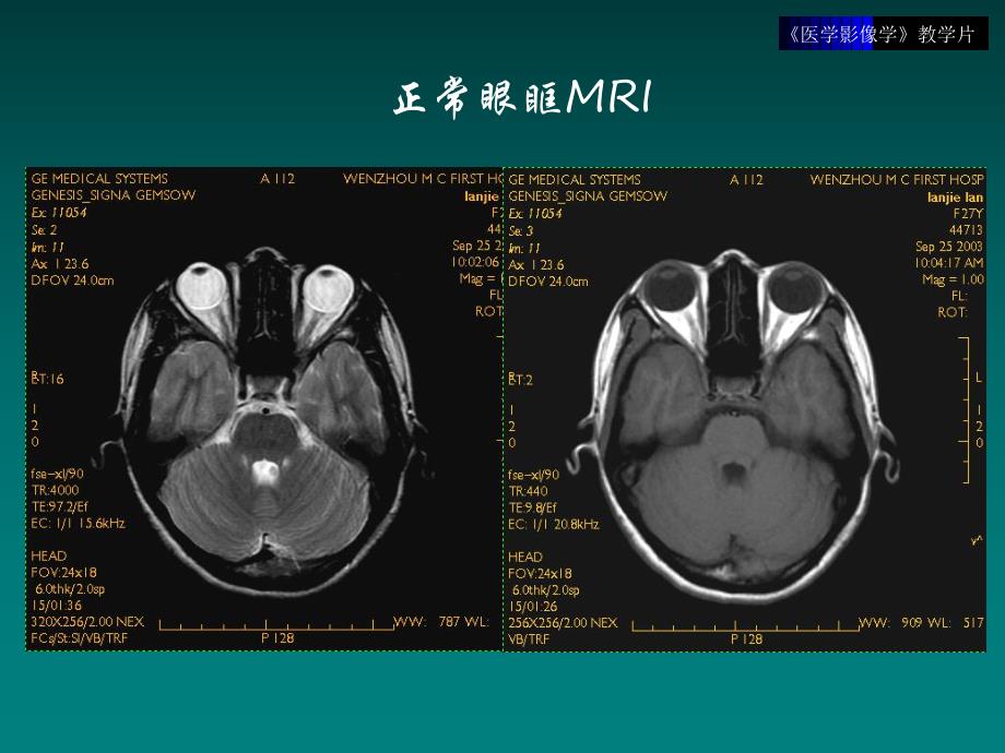 影像学 五官头颈部.ppt_第3页