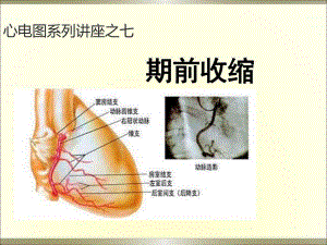 心电图系列讲座7期前收缩.ppt