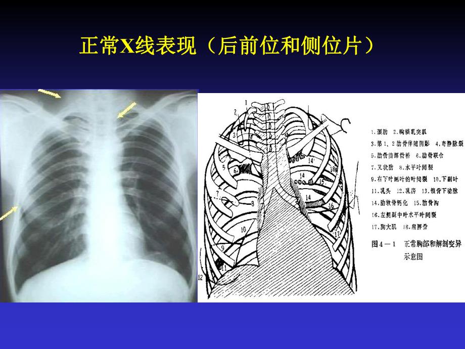 呼吸系统X线诊断名师编辑PPT课件.ppt_第2页