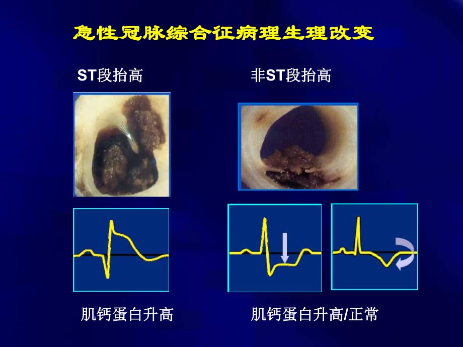 ACS更新指南中的抗栓治疗.ppt_第2页