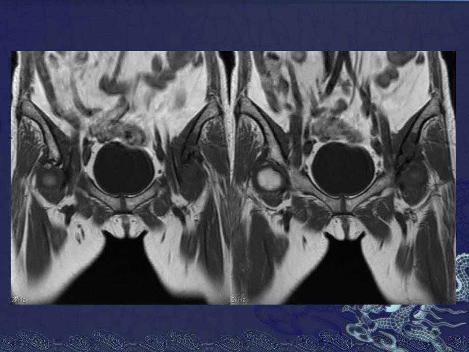 发育性髋关节发育不良1.ppt_第2页