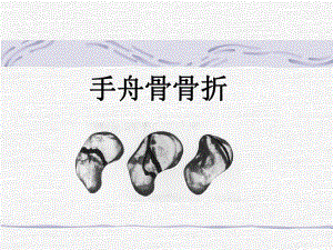 手舟骨骨折.ppt