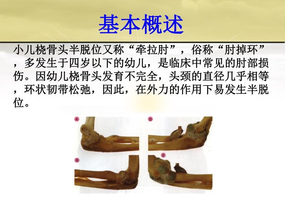 桡骨头半脱位(伤科学).ppt.ppt_第2页