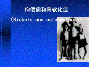 佝偻病和骨软化症.ppt