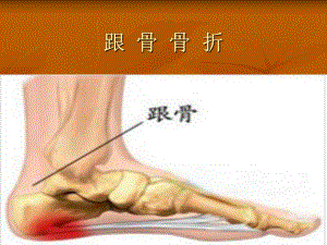 跟骨骨折护理.ppt