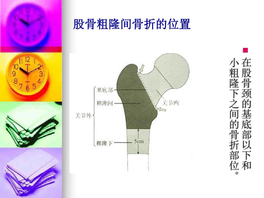 股骨粗隆间骨折围手术期.ppt_第3页