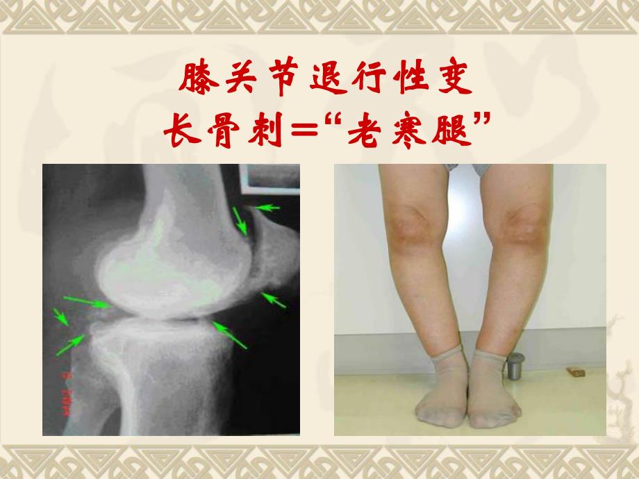 膝关节病健康教育.ppt_第3页