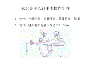 钛合金空心钉手术操作步骤.ppt