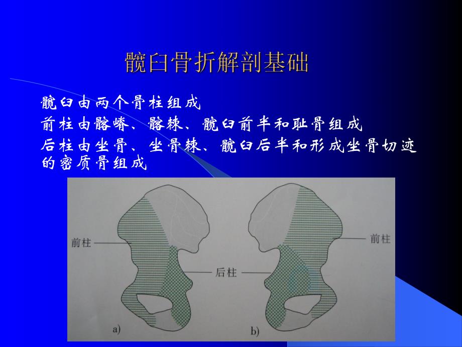 髋臼骨折的诊治难点分析.ppt_第2页
