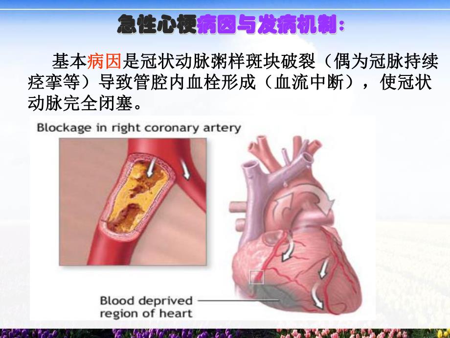 急性心梗溶栓的护理.ppt_第3页