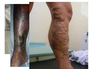 深静脉血栓病人的护理.ppt