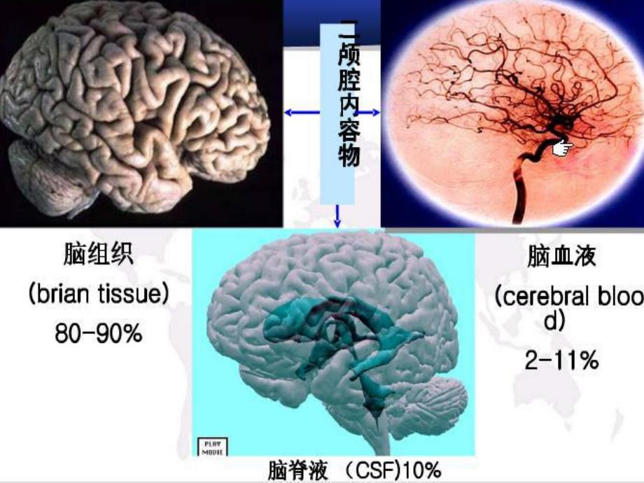 颅内压增高病人的护理.ppt_第3页
