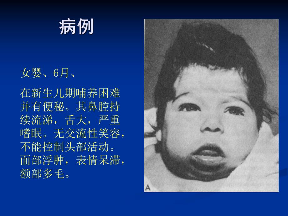 儿科学笔记……内分泌疾病甲减.ppt.ppt_第2页