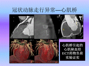 心血管疾病64层CTA诊断（三） .ppt