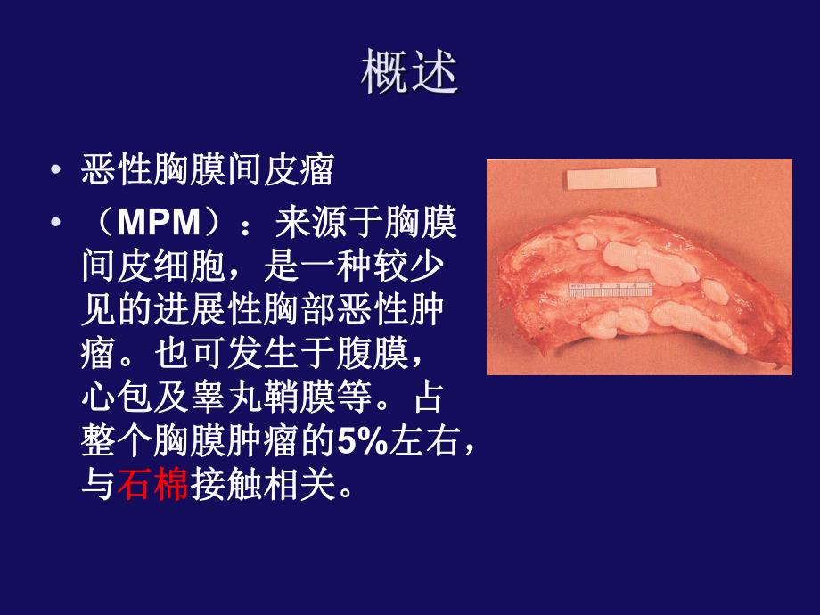 恶性胸膜间皮瘤诊治进展 华晶【ppt】 .ppt_第2页