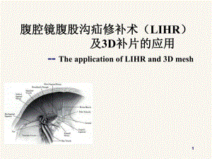 腹腔镜腹股沟疝修补术.ppt.ppt
