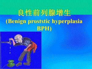 良性前列腺增生ppt.ppt
