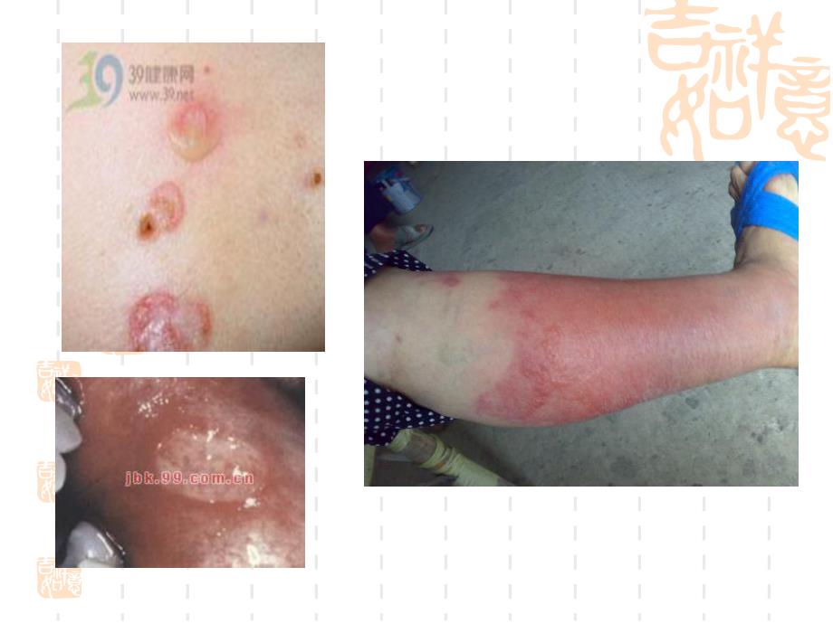 静脉用胺碘酮引起静脉炎的预防与处理 医学ppt.ppt_第3页