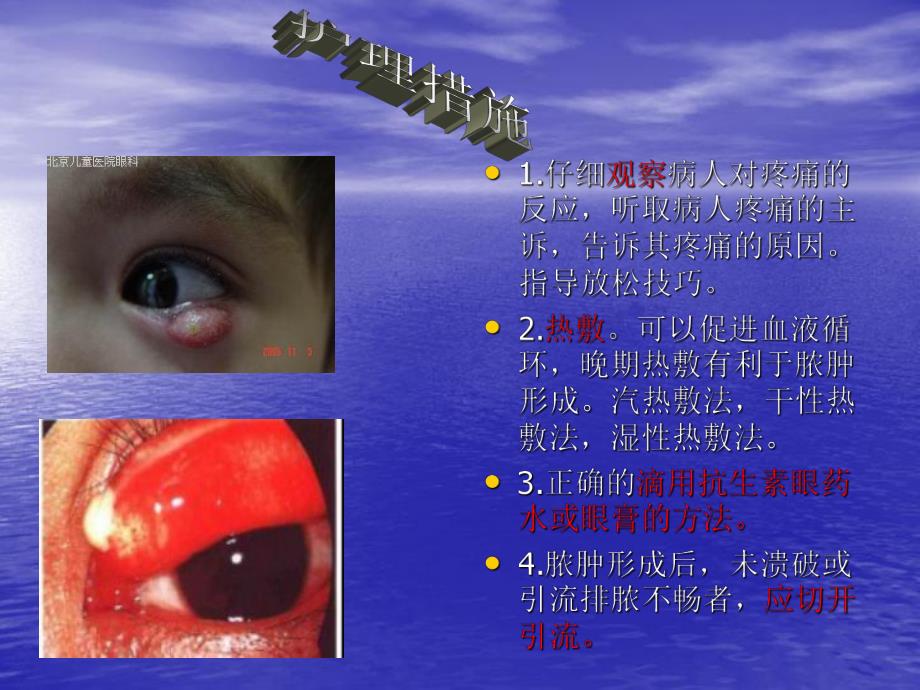 眼科病人的护理.ppt_第3页