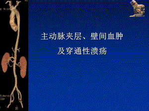 主动脉夹层、壁间血肿及穿通性溃疡.ppt