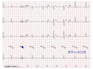 心电图常见正常和异常心电图图谱.ppt