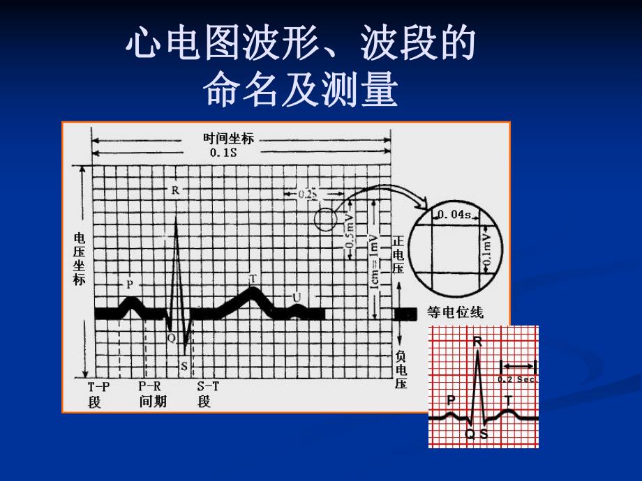 [整理版]心电图,三基培训.ppt_第3页