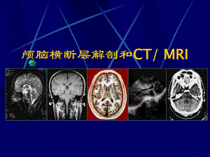 颅脑横断层解剖和CT、MRI.ppt