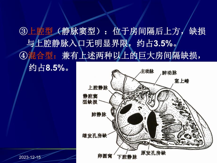 超声诊断学一先天性心脏病.ppt_第3页