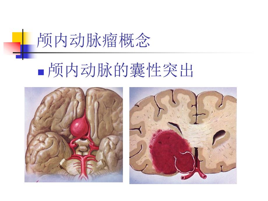 颅内动脉瘤的血管内治疗.ppt_第2页
