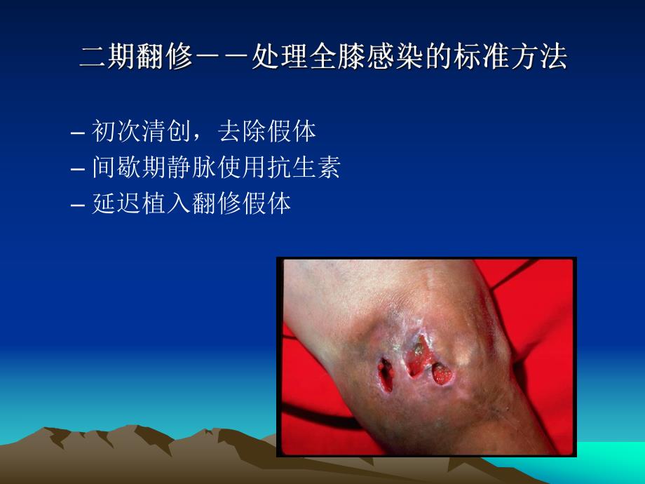 全膝感染二期返修.ppt_第3页
