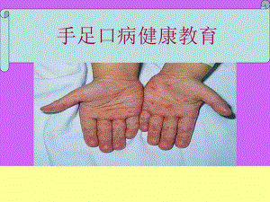 手足口病健康教育.ppt
