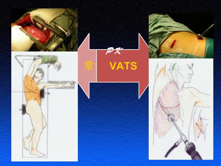 全胸腔镜下肺叶切除治疗肺癌.ppt_第3页