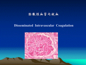DIC与肿瘤.ppt