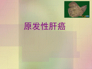 【原发性肝癌本科班课件】医学课件ppt52页.ppt
