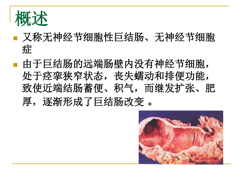 先天性巨结肠.ppt_第2页