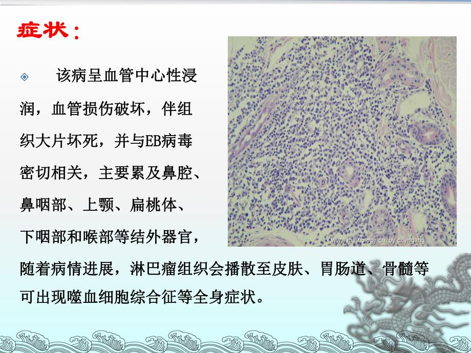 NK／T细胞淋巴瘤.ppt_第2页