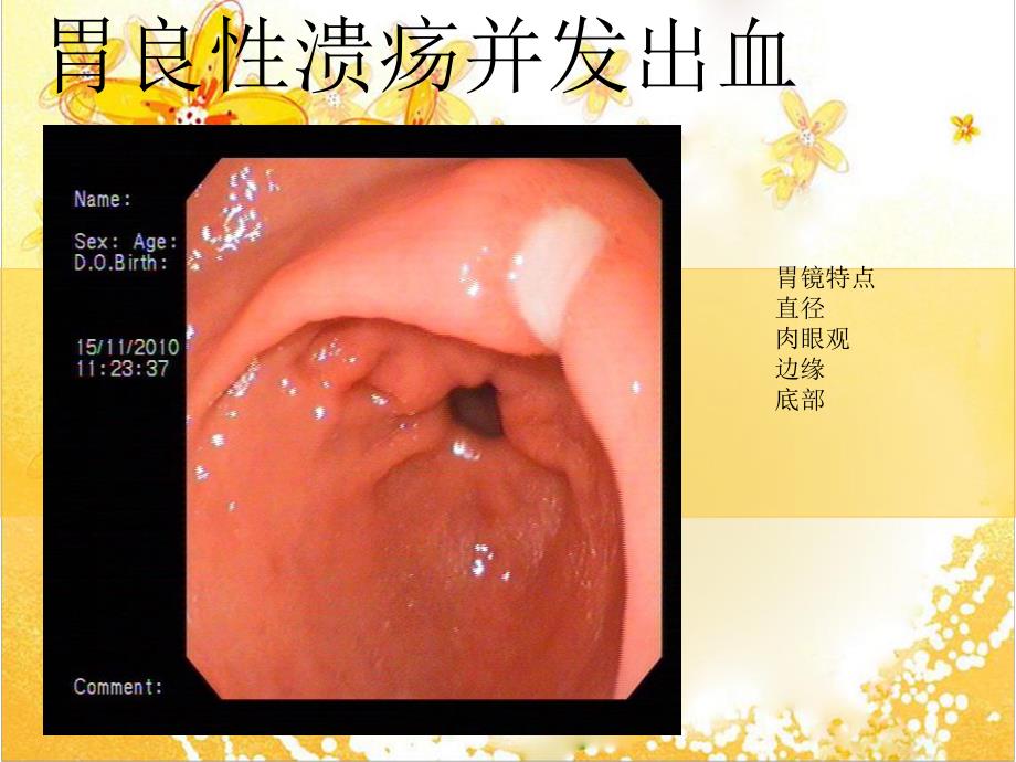 胃癌的鉴别诊断.ppt_第3页